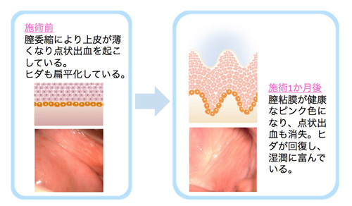 性交痛のヒリヒリへの先進施術を徹底比較―モナリザタッチ・フェムフロー・モナフローⓇ・ヨニRF……何がどう違う?【名古屋・咲江レディスクリニック 丹羽院長監修】