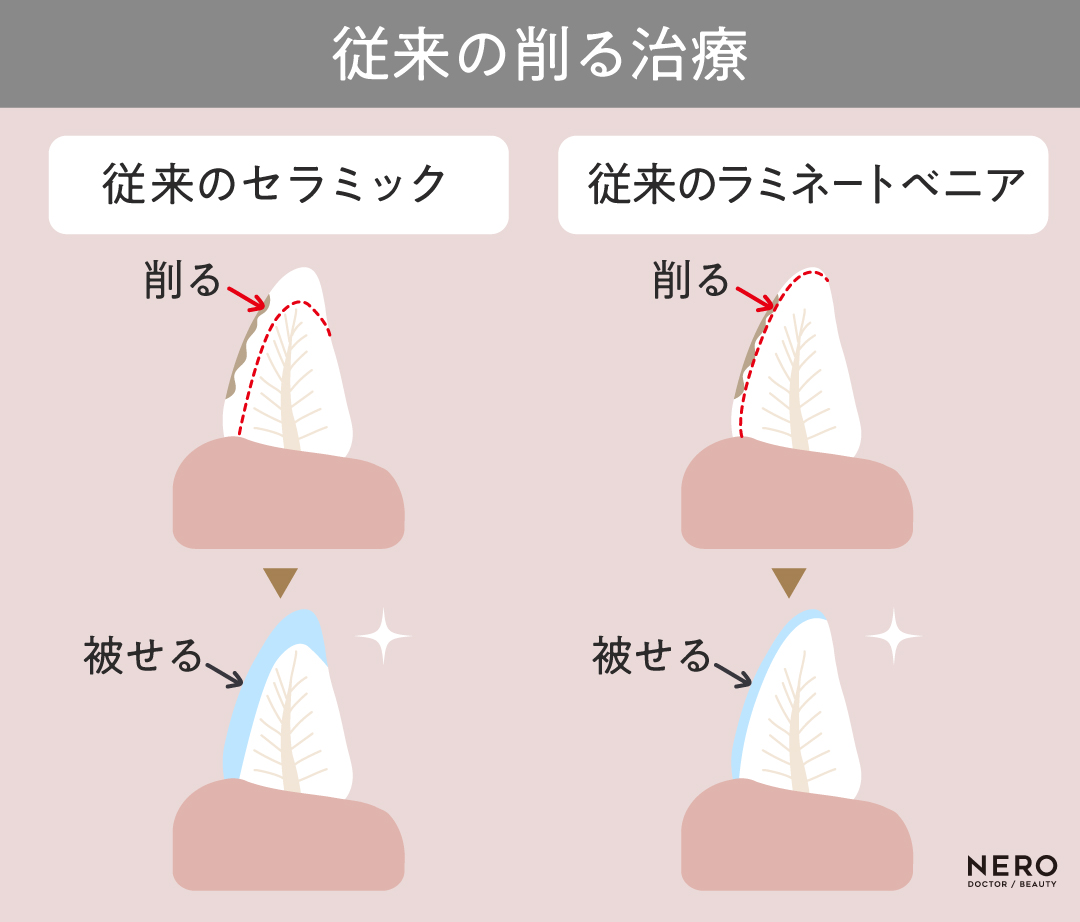 「削らないラミネートベニア」ブームから考える“白い歯の基準”とは？【ブラックフィルム】【ゼロネイト】時代の審美観｜NERO DOCTOR / BEAUTY（美容医療）