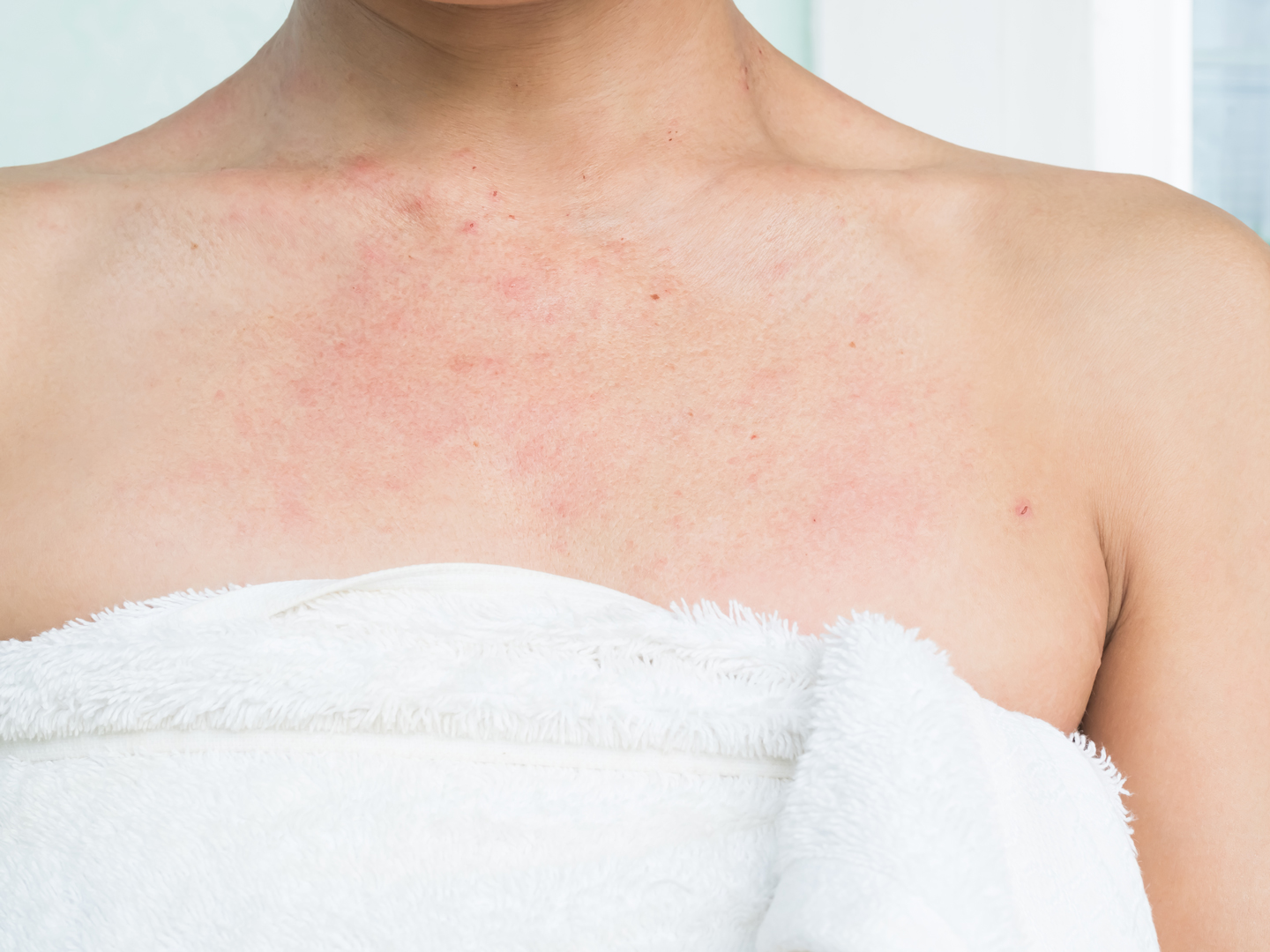 花粉症皮膚炎に負けない肌バリア強化治療とは｜NERO DOCTOR/BEAUTY（美容医療）