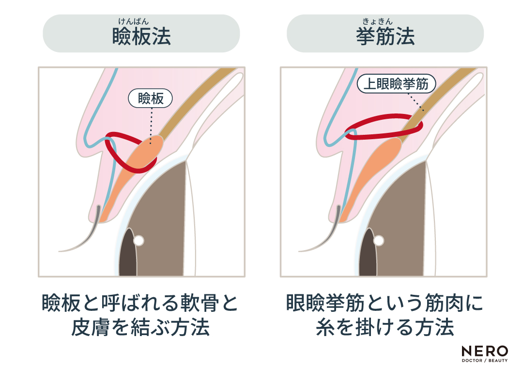 二重埋没の基本的な術式や注意点を解説！｜NERO DOCTOR / BEAUTY（美容医療）