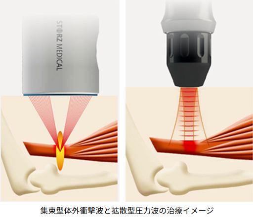 ショックウエーブで進化する美容医療―｜NERO DOCTOR/BEAUTY（美容医療）