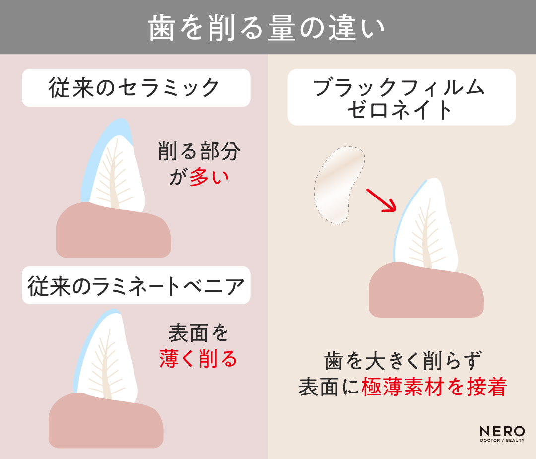 「削らないラミネートベニア」ブームから考える“白い歯の基準”とは？【ブラックフィルム】【ゼロネイト】時代の審美観｜NERO DOCTOR / BEAUTY（美容医療）