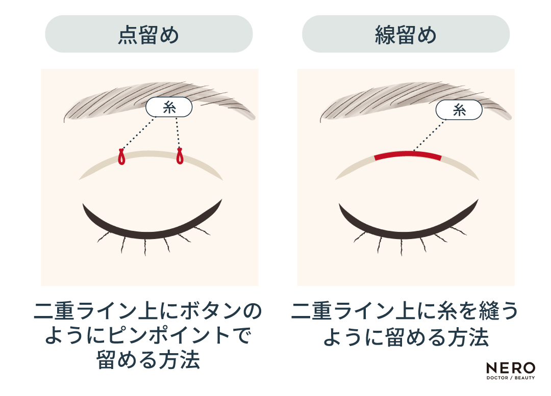 二重埋没の基本的な術式や注意点を解説！｜NERO DOCTOR / BEAUTY（美容医療）