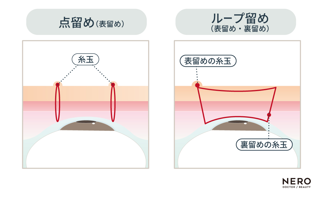 二重埋没の基本的な術式や注意点を解説！｜NERO DOCTOR / BEAUTY（美容医療）