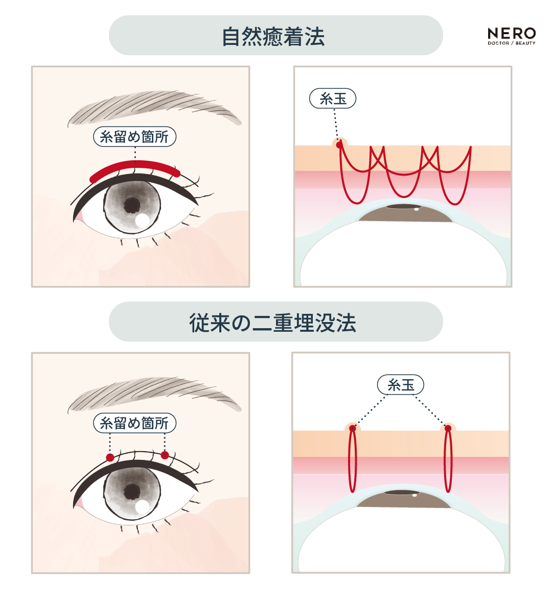 二重埋没の基本的な術式や注意点を解説！｜NERO DOCTOR / BEAUTY（美容医療）