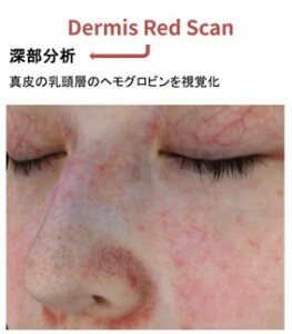 シンクレアアカデミーが日本の美容医療を変える！世界基準の肌診断を学べるウェビナーを独自取材