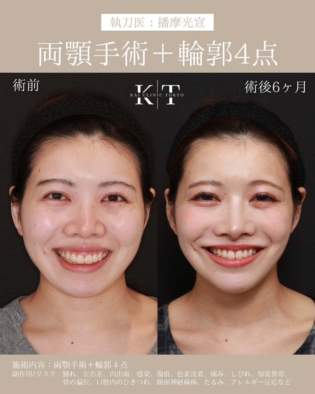 【医師監修】本気で顔を小さくしたい骨格悩み口ゴボ|NERO美容医療