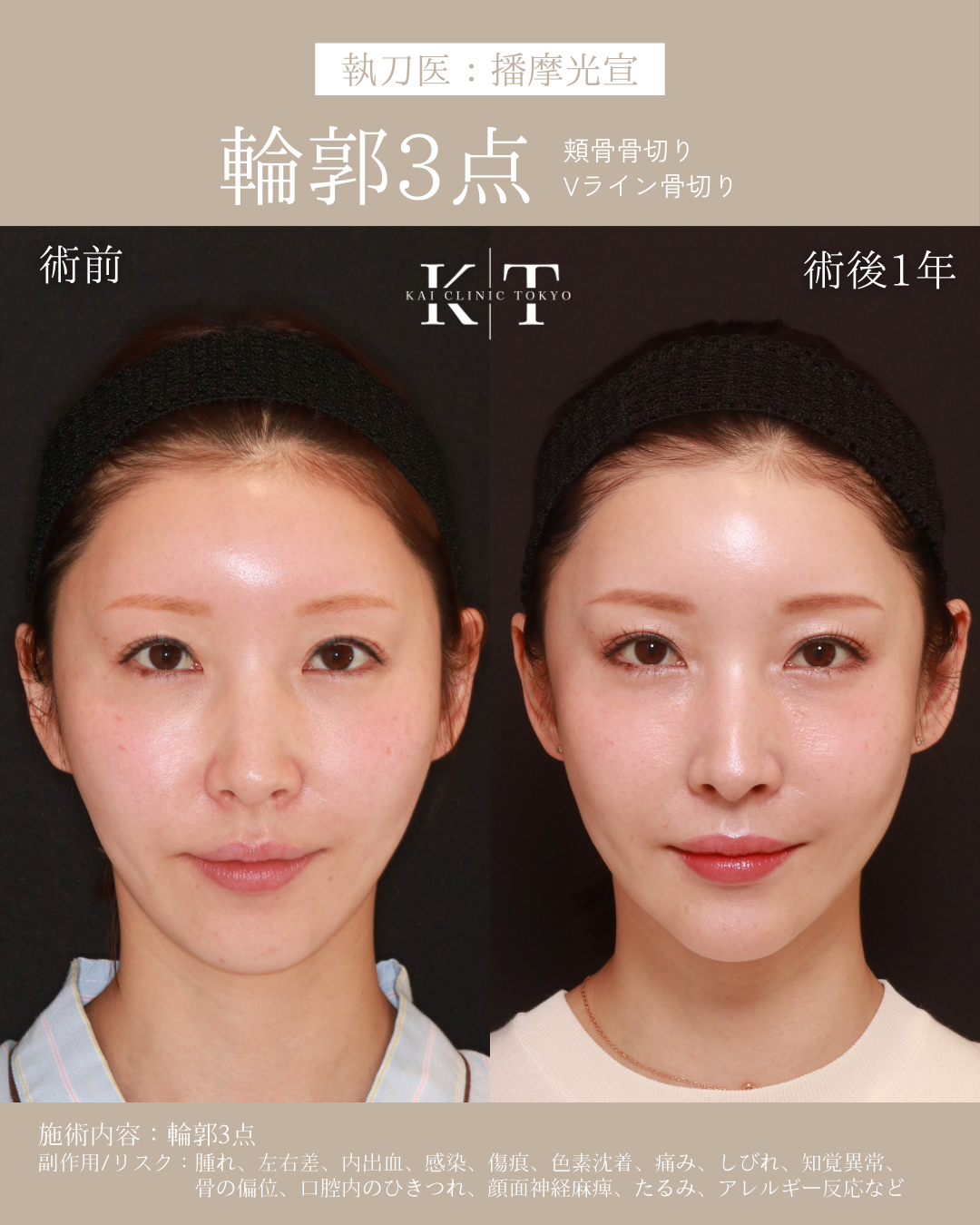 【医師監修】輪郭3点とは？骨切り設計の秘訣｜NERO美容医療