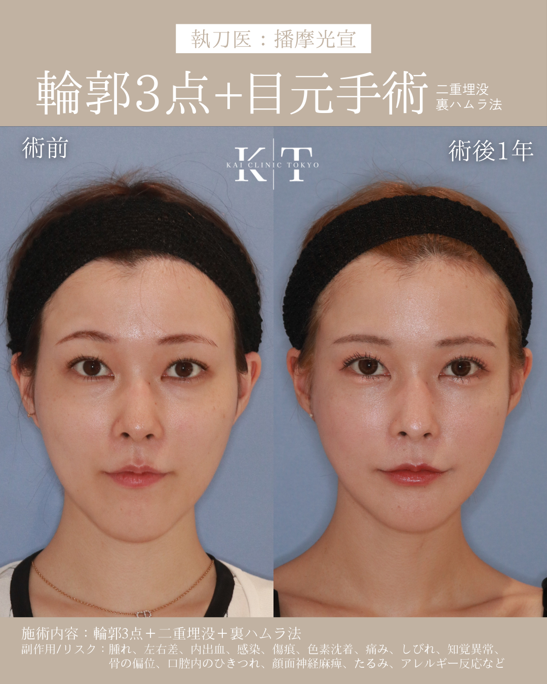 【医師監修】輪郭3点とは？骨切り設計の秘訣｜NERO美容医療