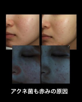顔の赤みの原因は自己流スキンケアに潜む？効果的な治療は正しい診断から！