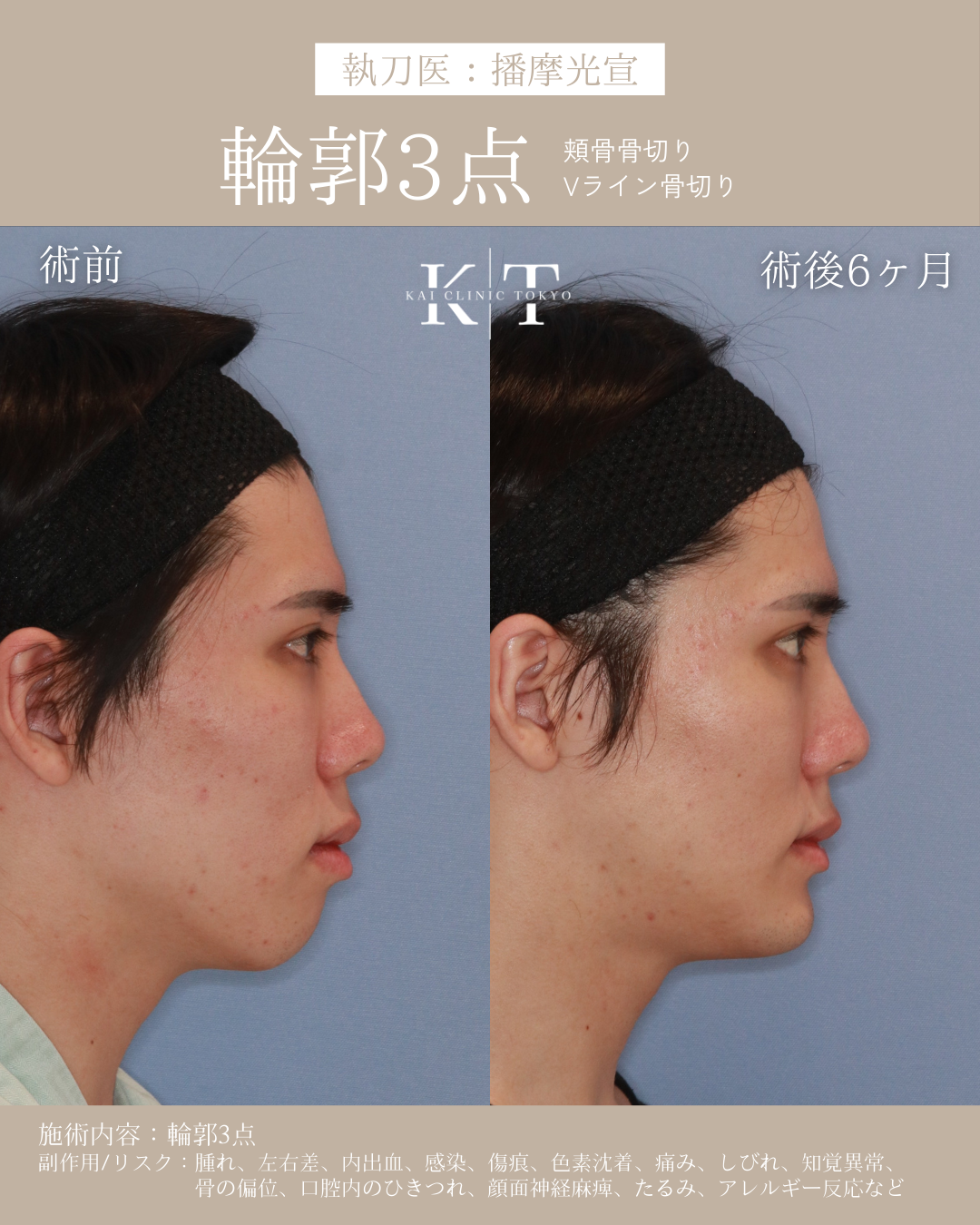 【医師監修】本気で顔を小さくしたい骨格悩み口ゴボ|NERO美容医療