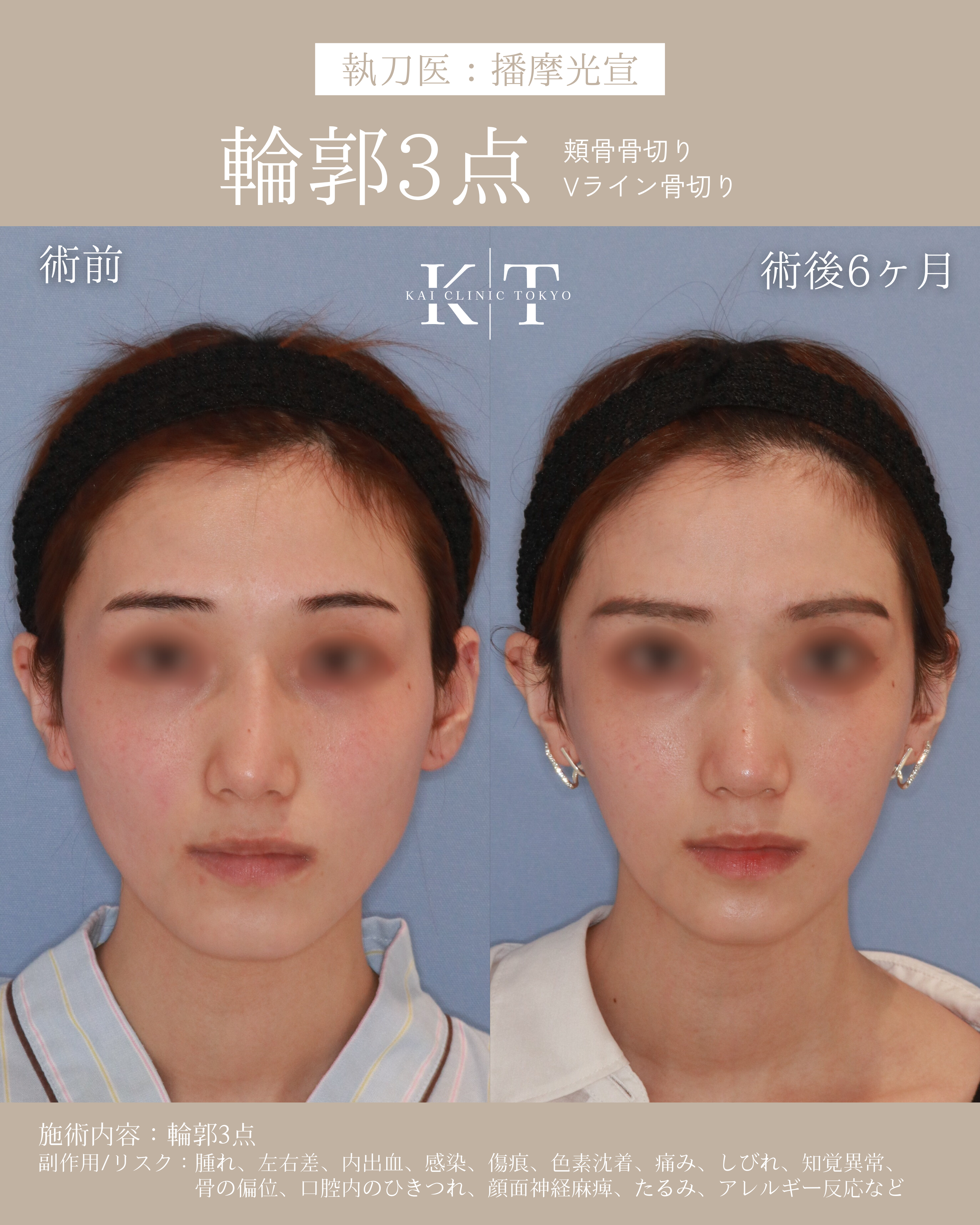 【医師監修】輪郭3点とは？骨切り設計の秘訣｜NERO美容医療