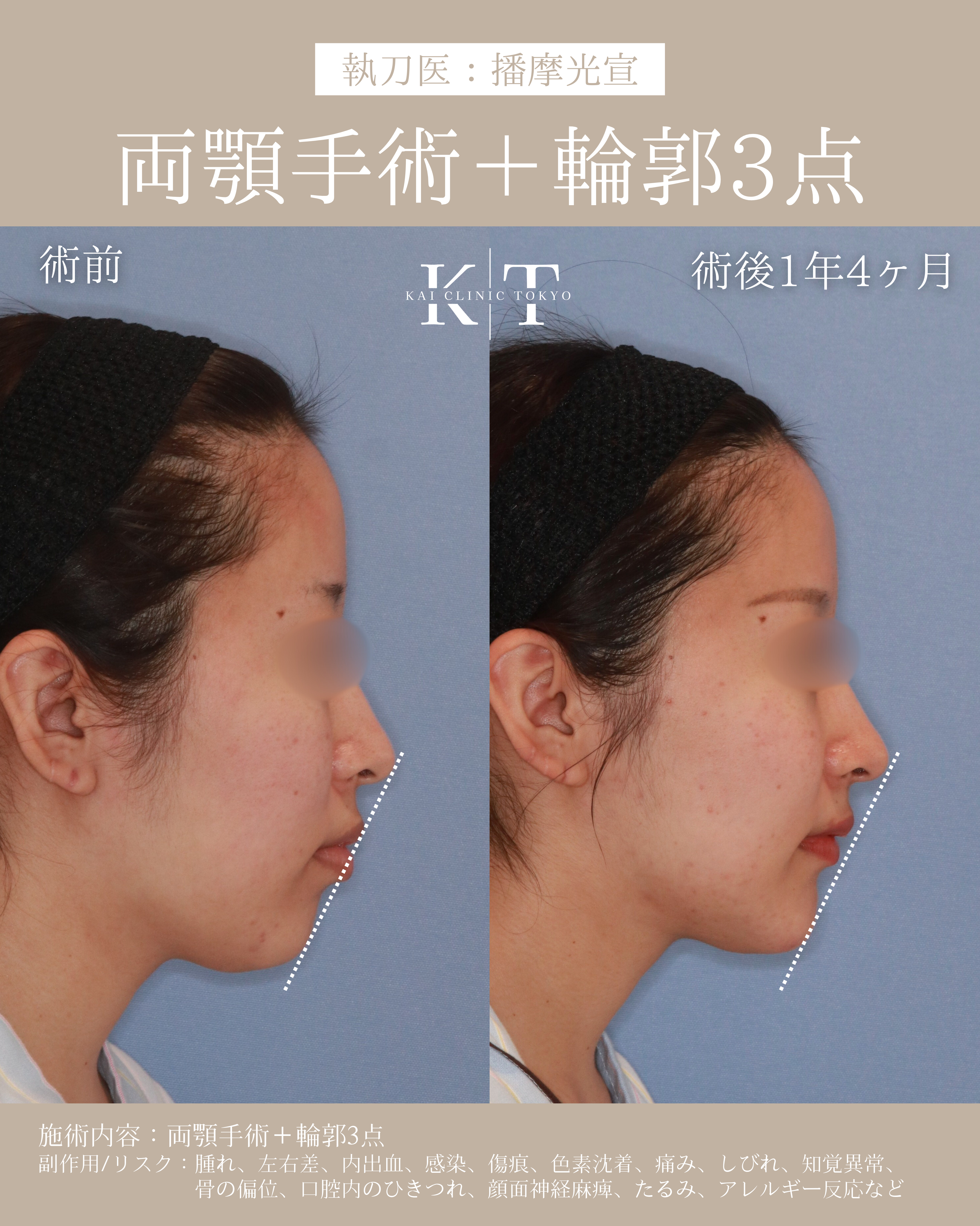 【医師監修】本気で顔を小さくしたい骨格悩み口ゴボ|NERO美容医療