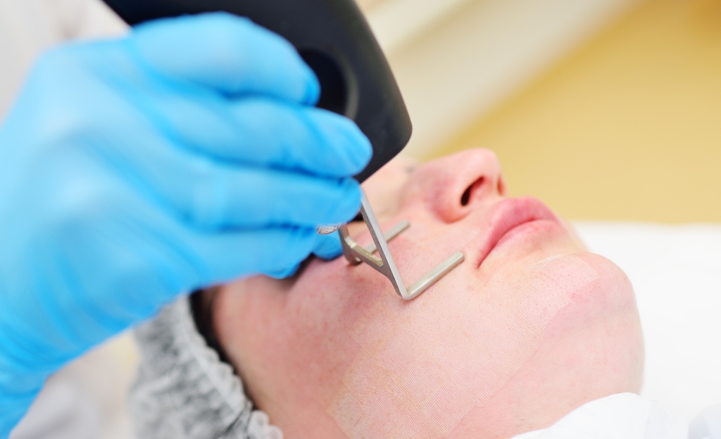 フラクショナルCO2レーザーとは？効果・経過・ダウンタイムを徹底解説｜ニキビ痕・毛穴・傷痕治療に選ばれる理由