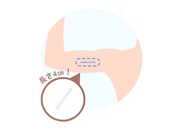 避妊インプラントを説明するイメージ図