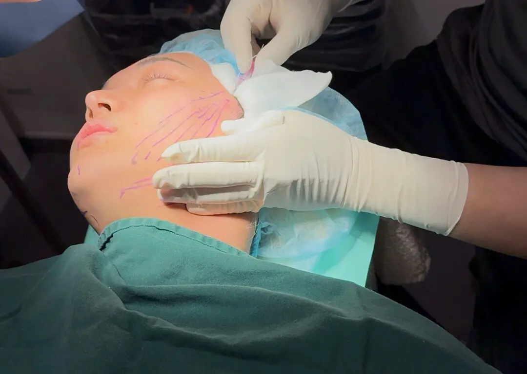 AELLE CLINIC(アエルクリニック)の糸リフトの施術シーン