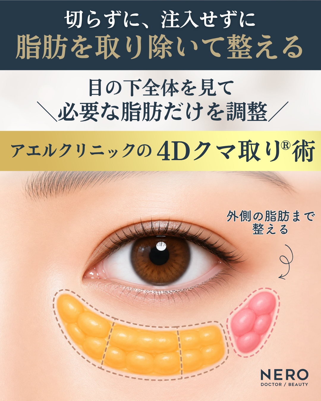 切らずに注入せずに、目頭から目尻側の外側の脂肪まで精密に整えてクマを改善する4Dクマ取り®術の施術イメージ図