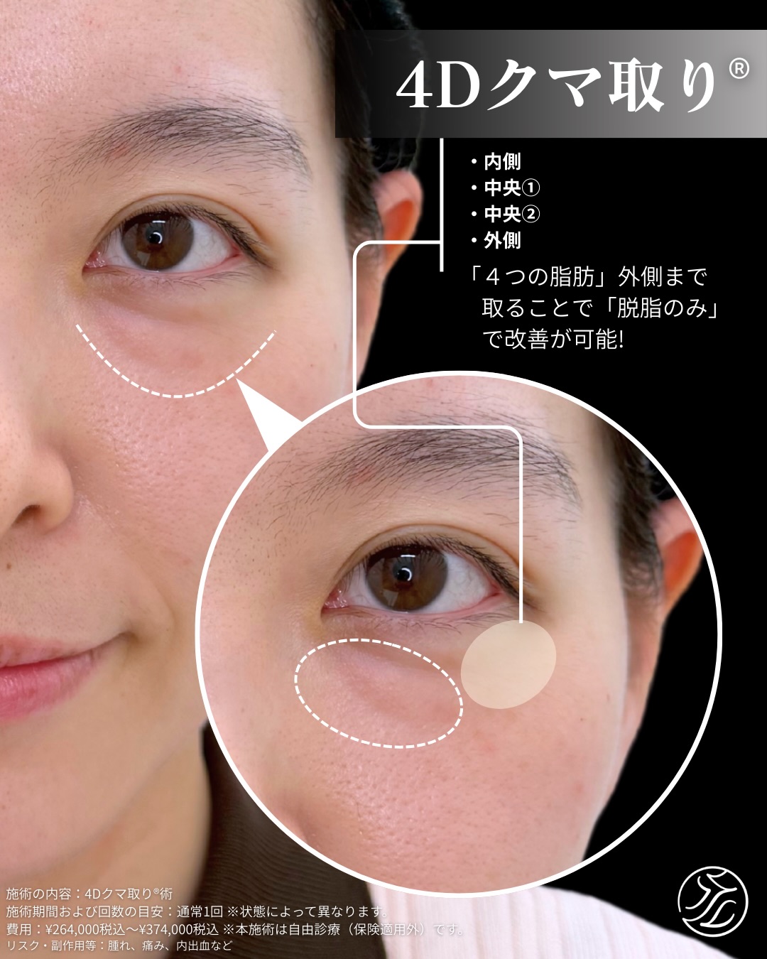 脂肪を取るだけでなく、自然に整えることで“若々しく明るい目元になれる「4Dクマ取り®」の施術範囲を示す写真