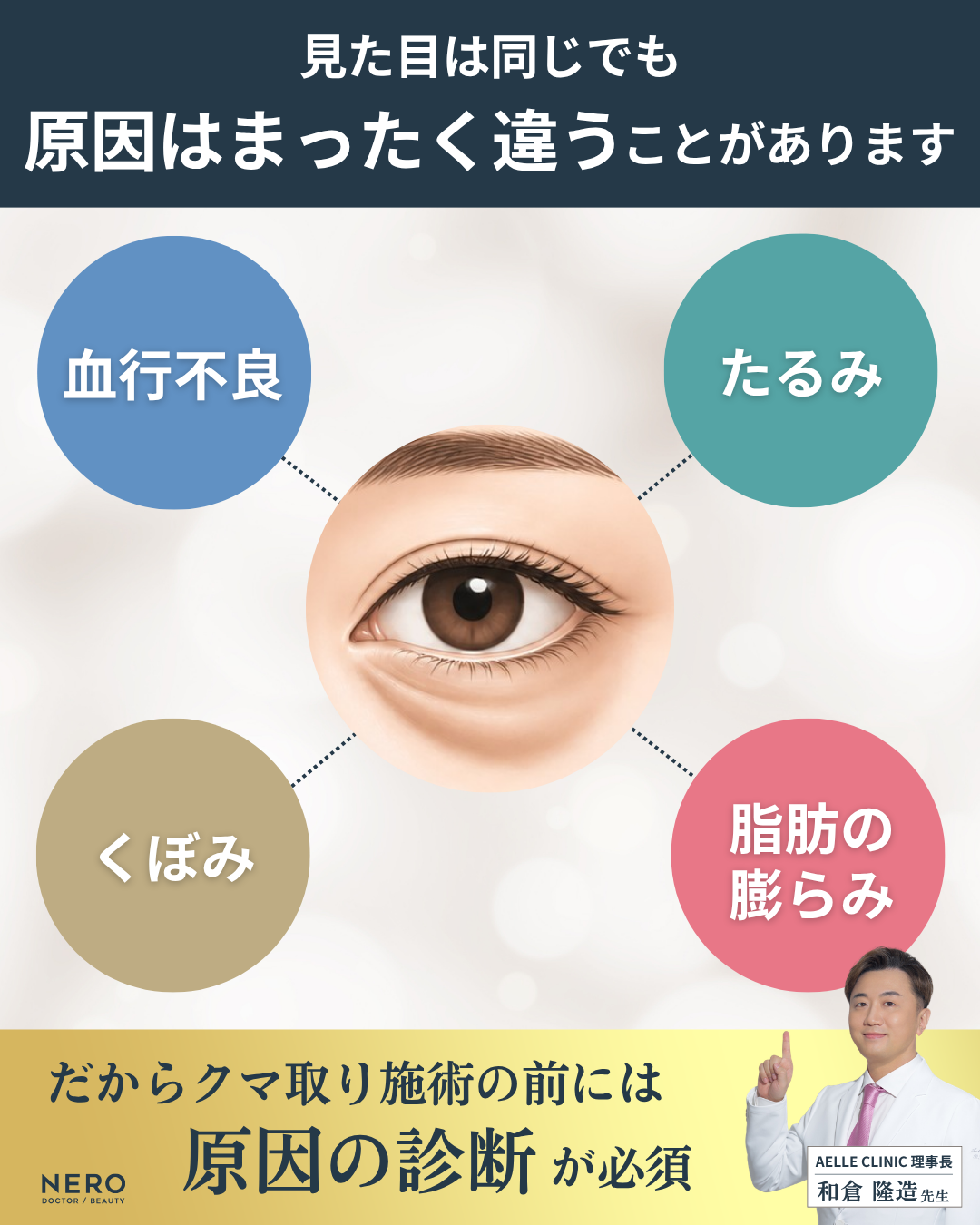 目の下のクマの原因として血行不良・たるみ・くぼみ・脂肪膨らみの違いを示す図。クマ取り施術前の診断が重要