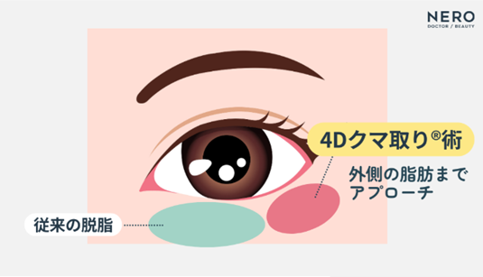 アエルクリニックの4Dクマ取り®術の脂肪摘出範囲イメージ図