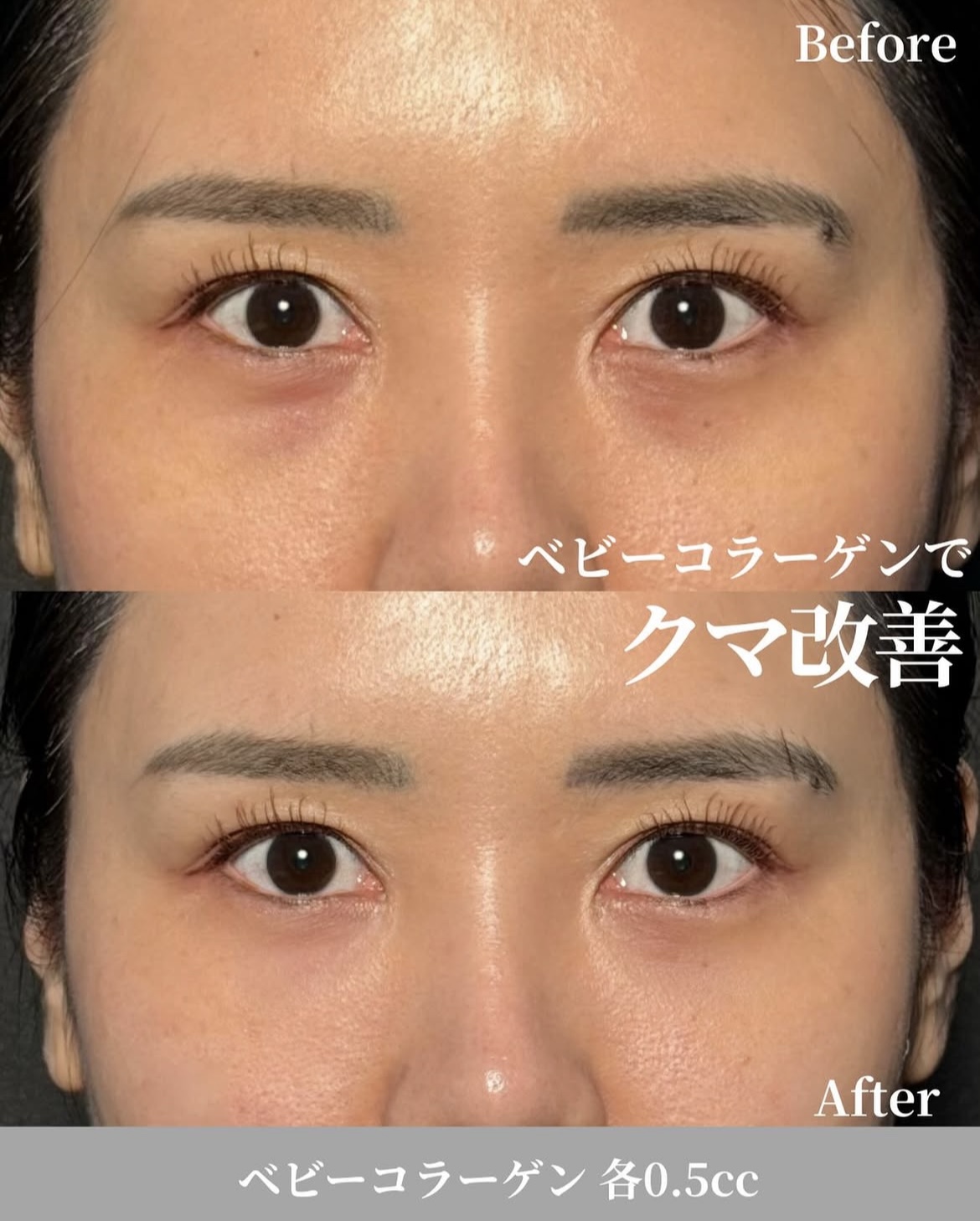 バンコク・ビビクリニックのコラーゲンブースター施術症例