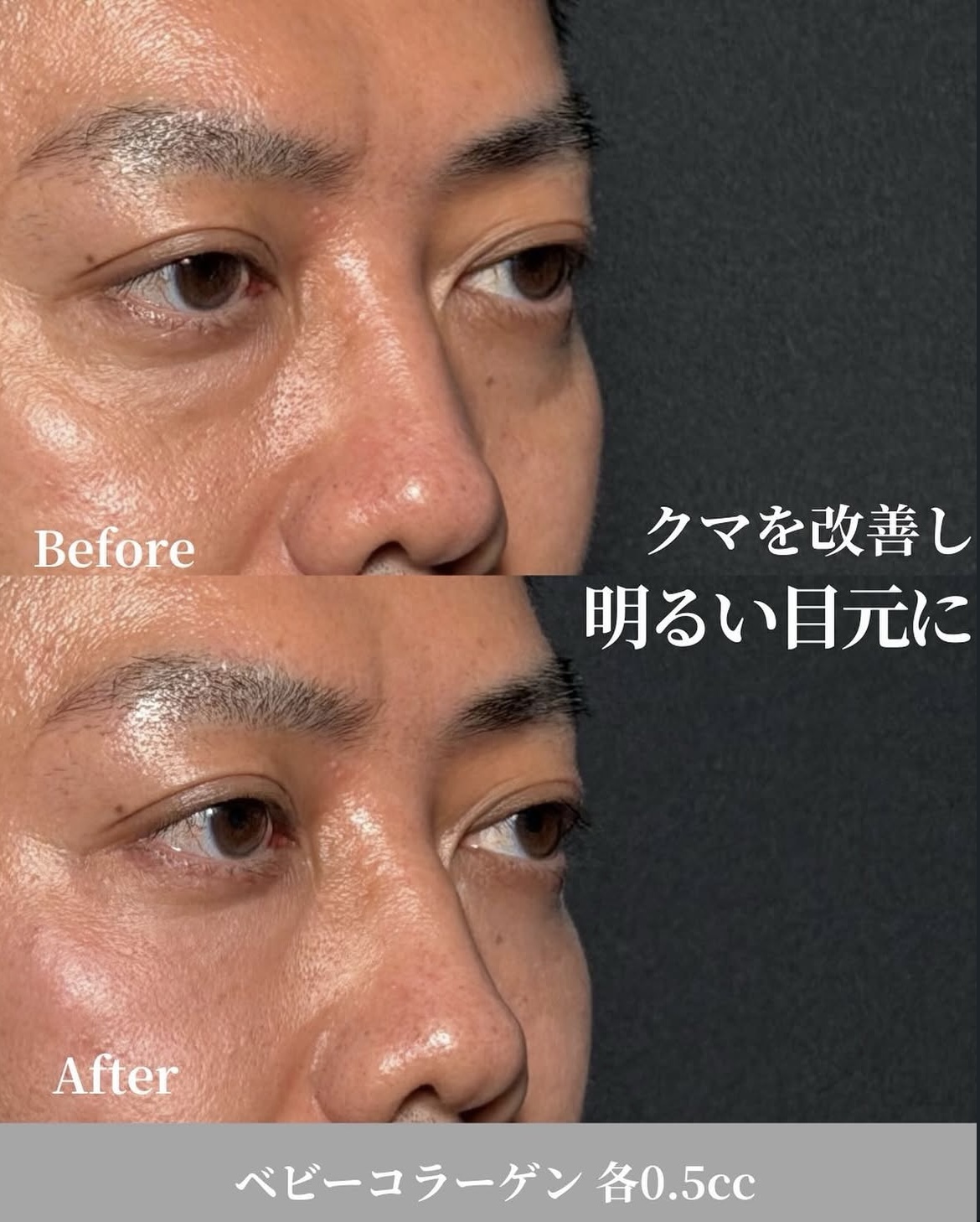 バンコク・ビビクリニックのコラーゲンブースター施術症例