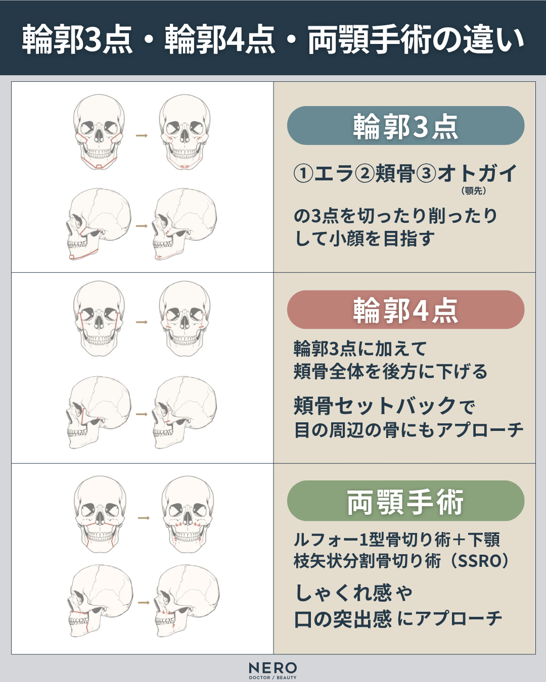 本気で顔を小さくしたいなら骨格から整える【輪郭3点】でここまで変わる！小顔と立体感を同時に叶える骨切り設計｜カイクリニック東京監修