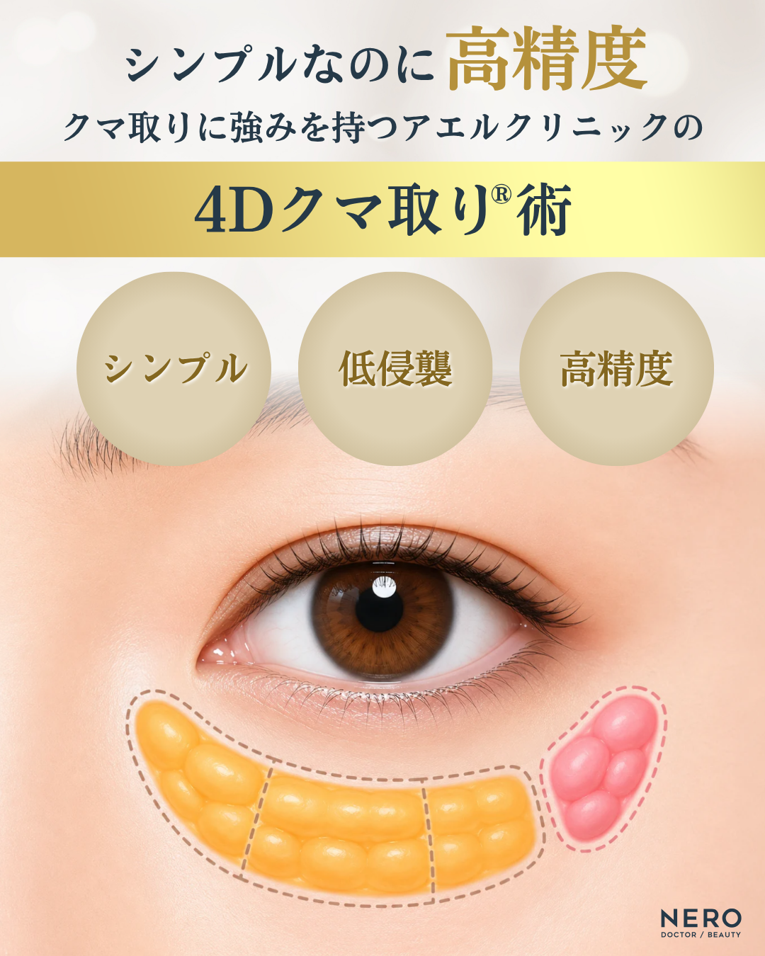 アエルクリニックの4Dクマ取り®術の特徴イメージ。シンプル・低侵襲・高精度なクマ取り施術