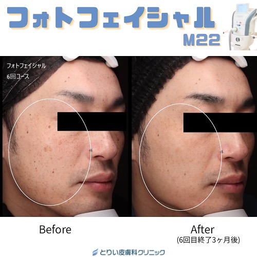 金沢・野々市市「とりい皮膚科クリニック」のフォトフェイシャルM22によるシミ取りの男性症例