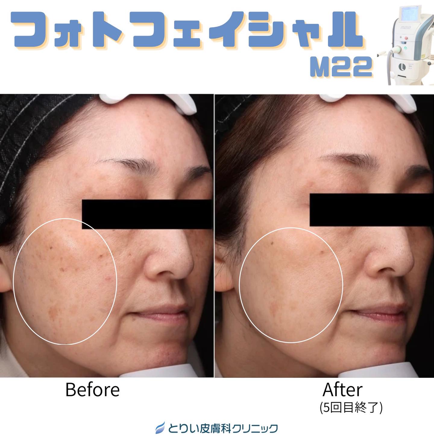 金沢・野々市市「とりい皮膚科クリニック」のフォトフェイシャルM22によるシミ取り症例