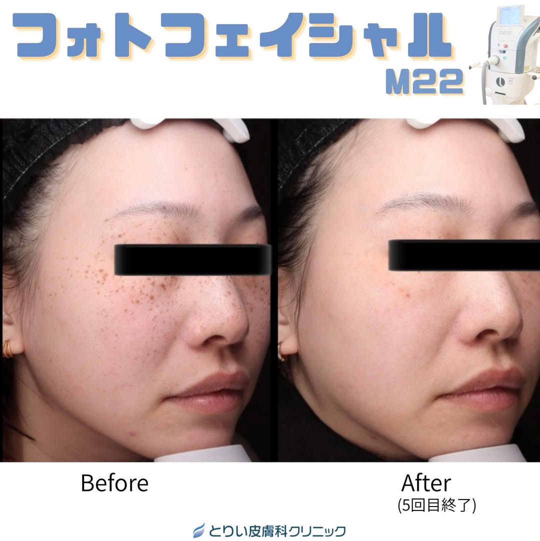 金沢・野々市市「とりい皮膚科クリニック」のフォトフェイシャルM22によるシミ取り症例