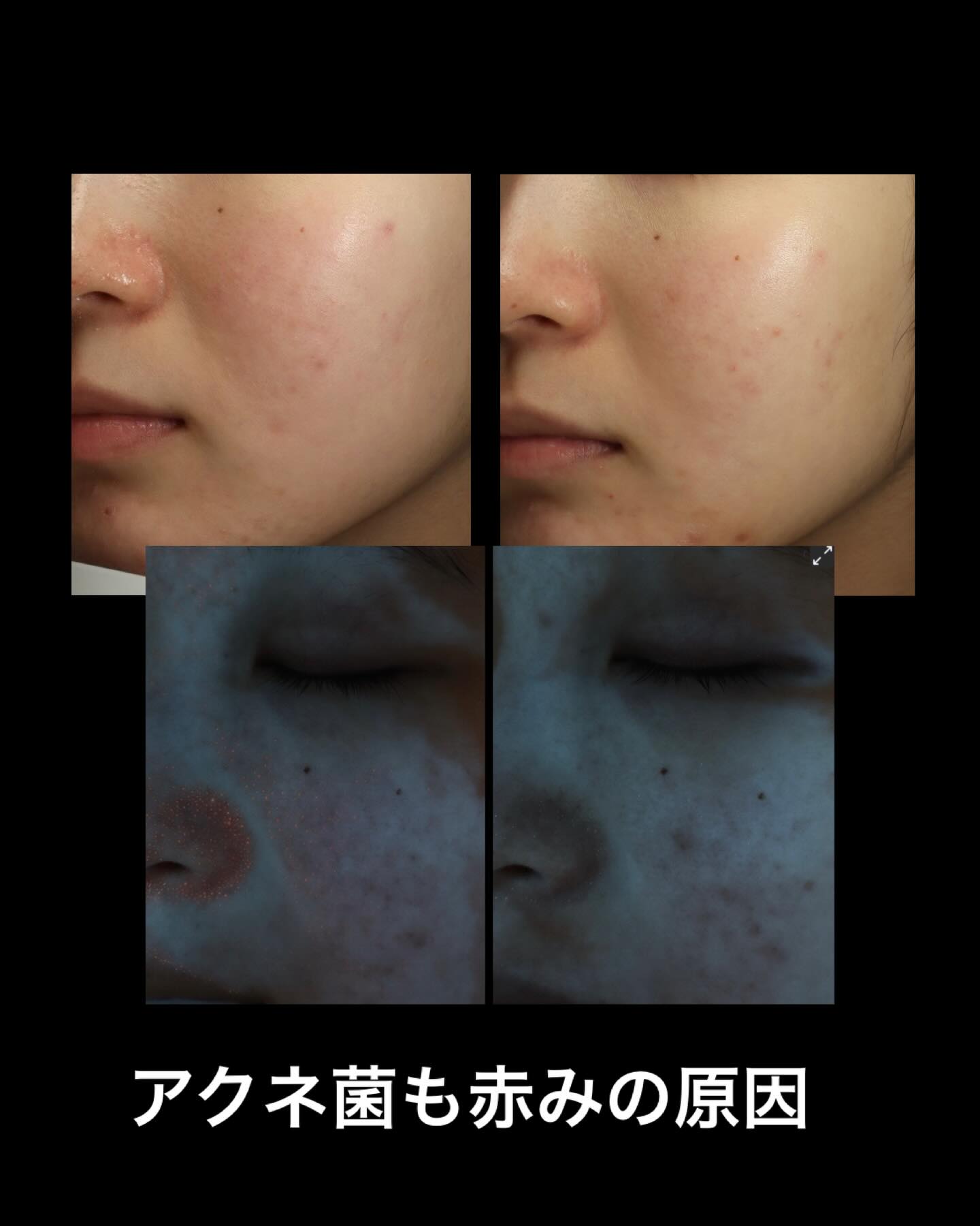 咲くらクリニックにて、VISIAによる画像解析で赤み・酒さの原因であるアクネ菌の増殖を確認した症例