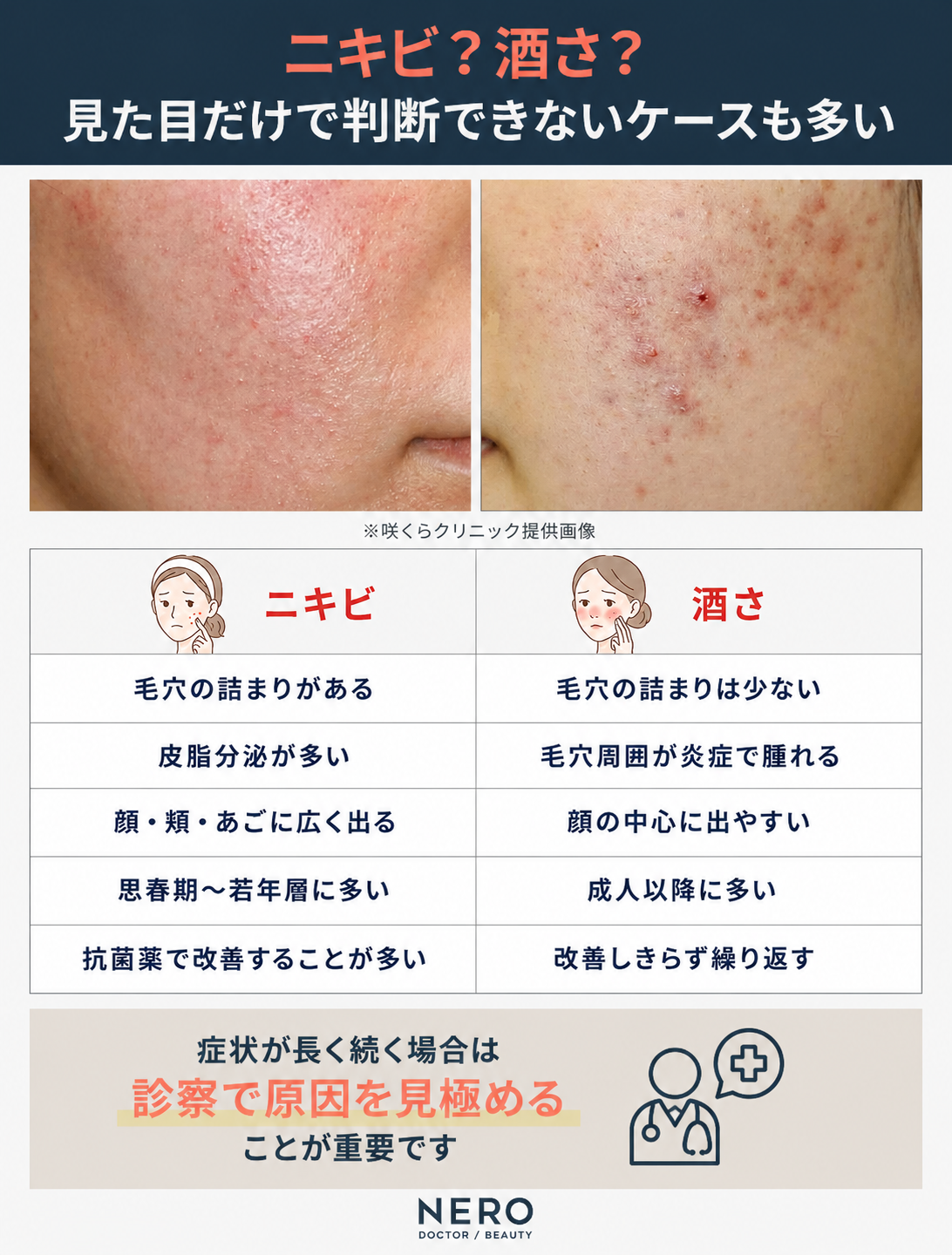 ニキビと酒さは見た目だけでは判断できないケースが多い|それぞれの特徴を比較