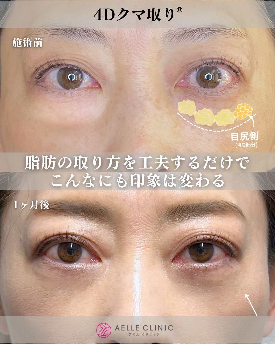アエルクリニック4Dクマ取り施術前後症例画像
