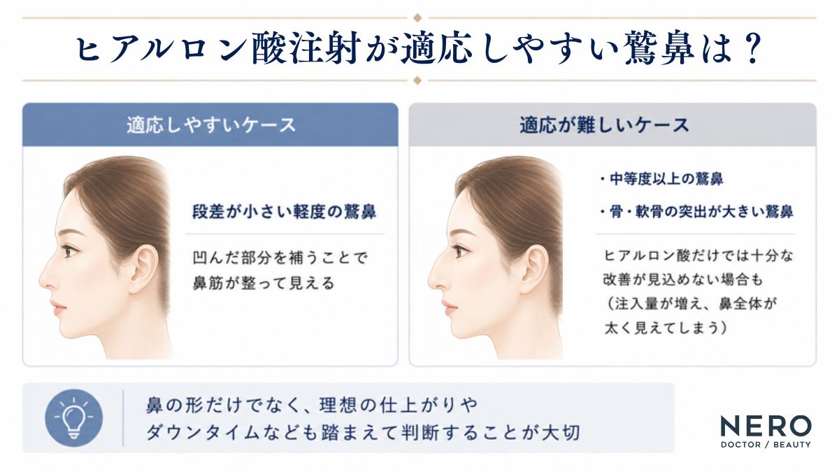 鷲鼻の程度別にヒアルロン酸注射の適応可否を比較した図解