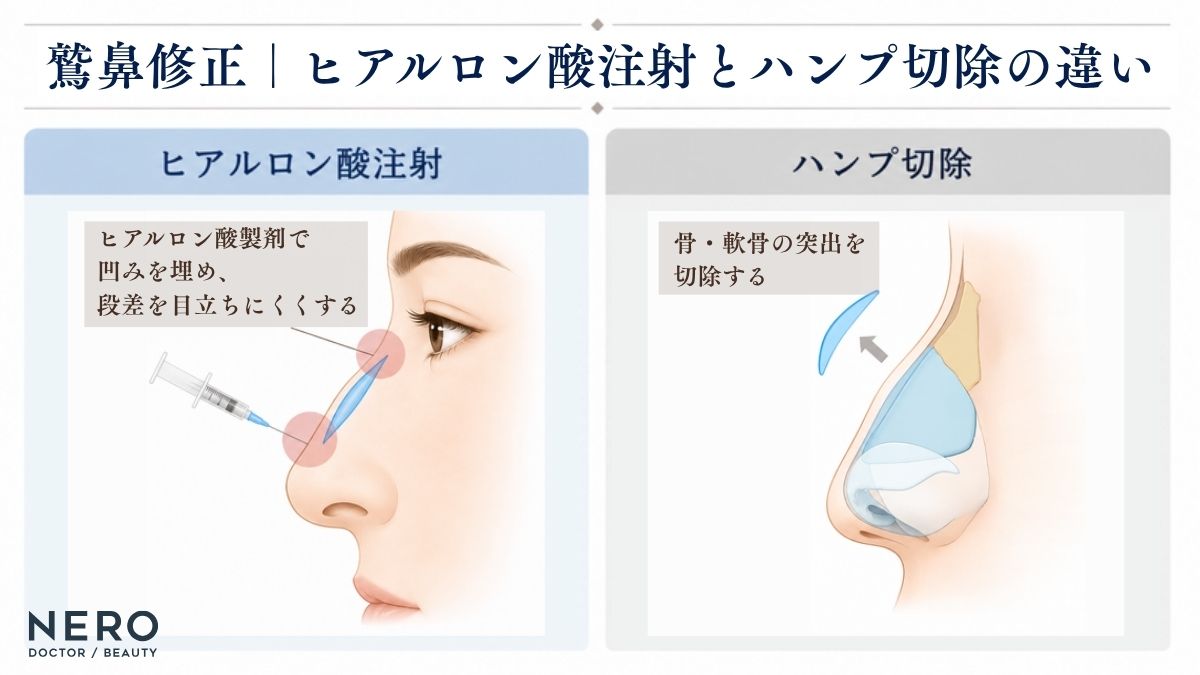 ヒアルロン酸注射とハンプ切除の違いを治療方法やダウンタイムで比較した図解