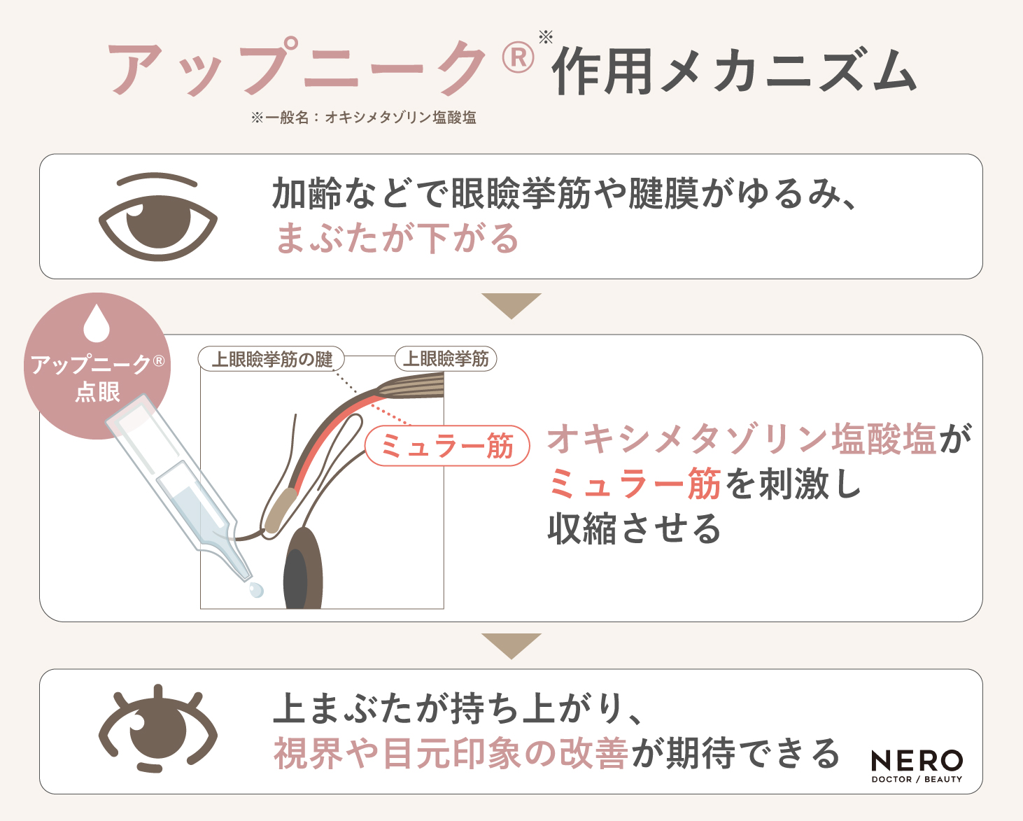 アップニークがまぶたを持ち上げる仕組みを示した図