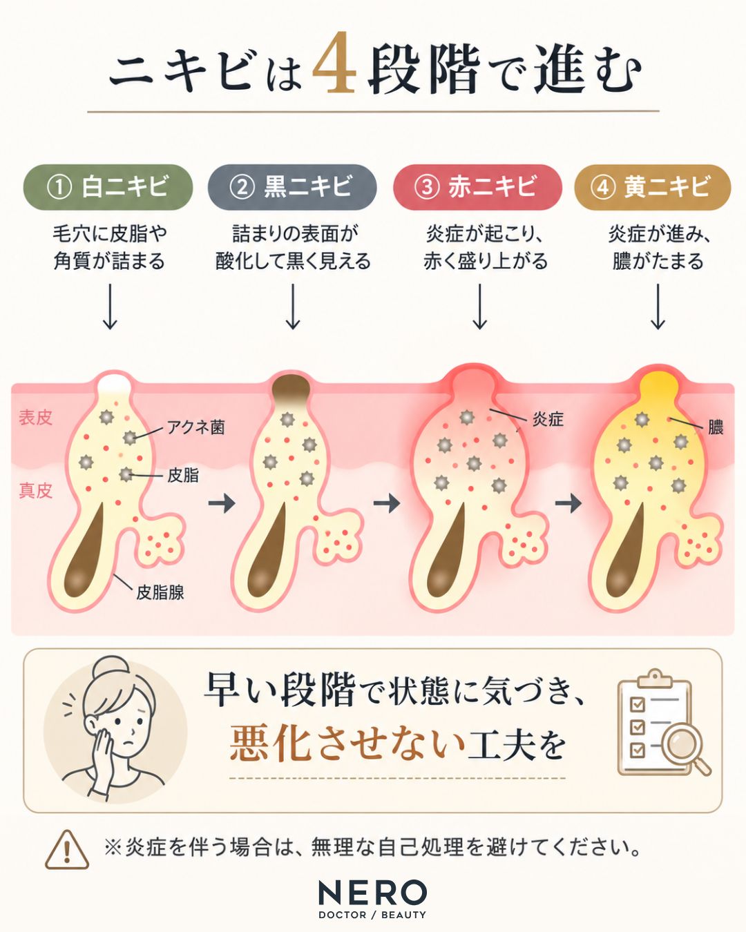 ニキビが白黒赤黄へ進む4段階の毛穴イラスト