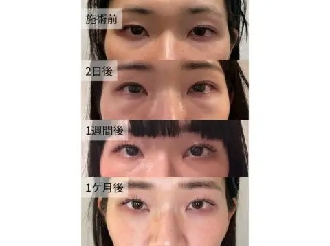 アエルクリニック4Dクマ取り®術施術前後の症例写真((施術前・施術後)2日1週間1か月後)
