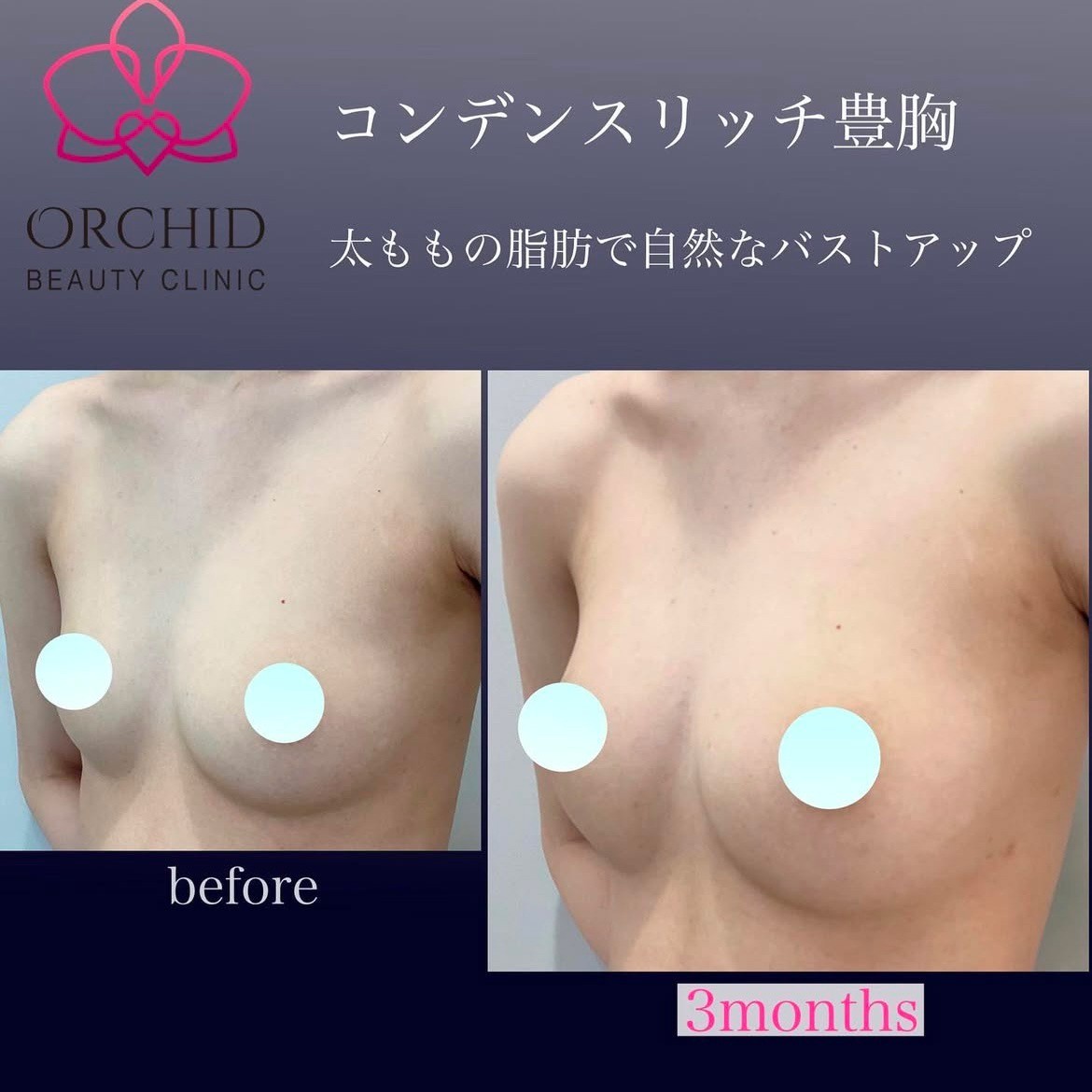 コンデンスリッチ豊胸施術前後の症例写真