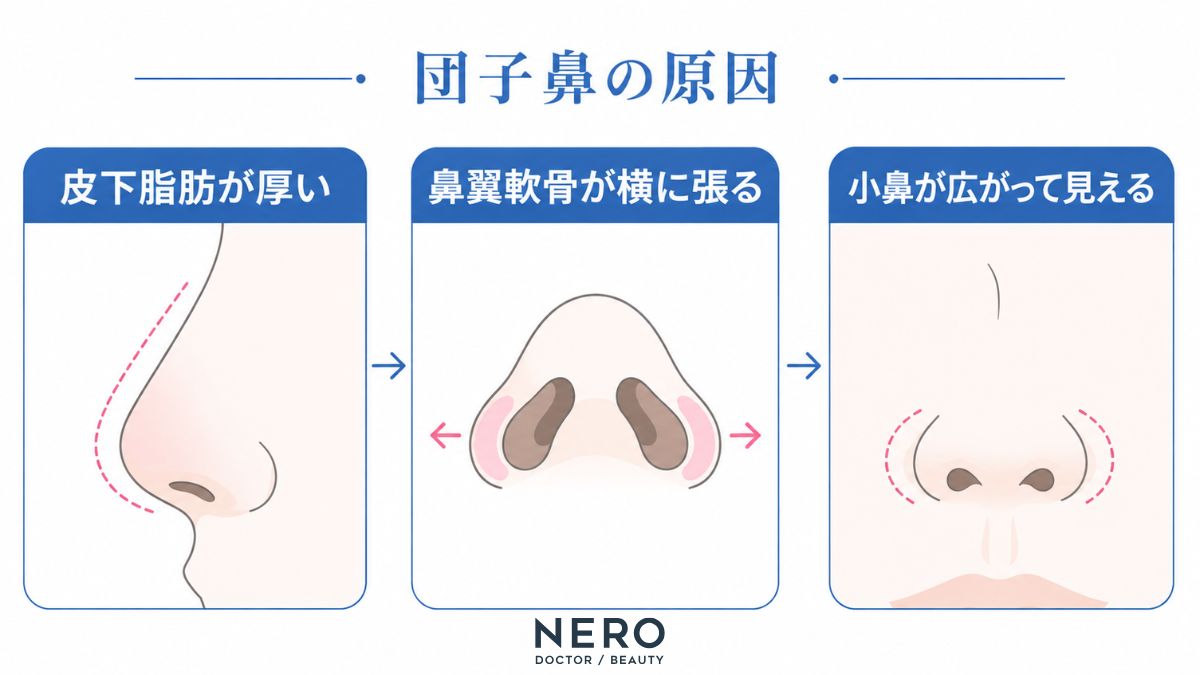 団子鼻の原因と見え方の関係を整理した概念図