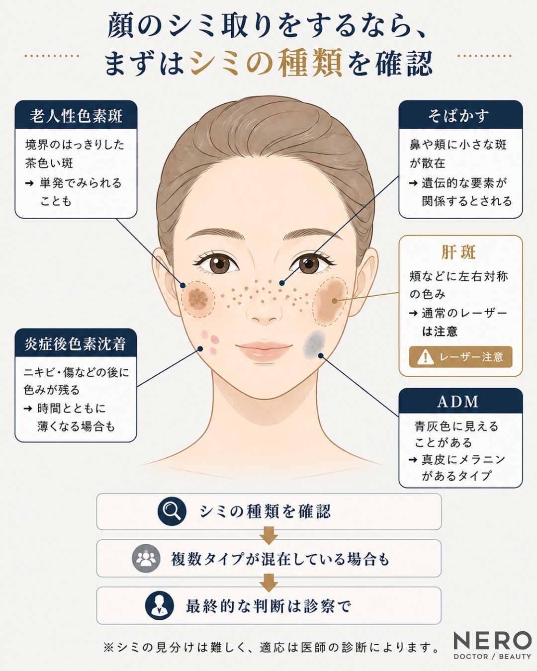 顔のシミの種類を部位と特徴から整理した診断フロー図