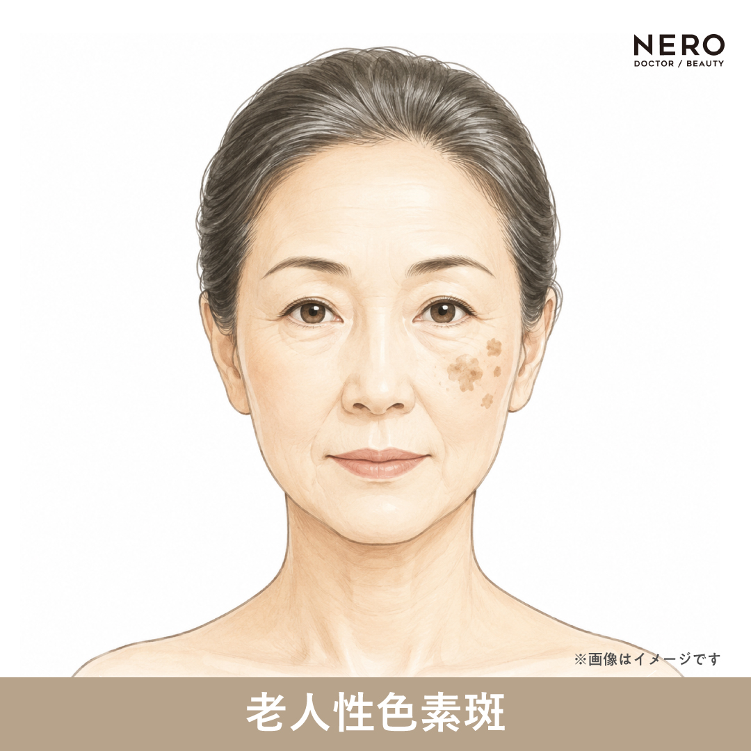 老人性色素斑の女性のイラスト