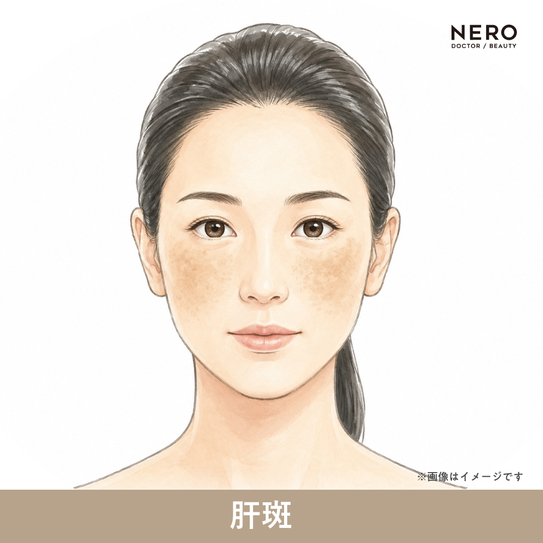 肝斑の女性のイラスト