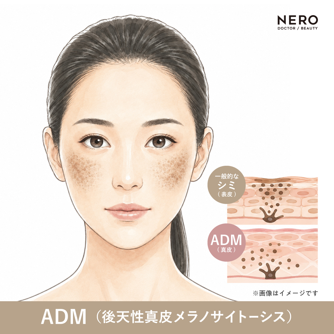 ADM(後天性真皮メラノサイトーシス)の女性のイラスト