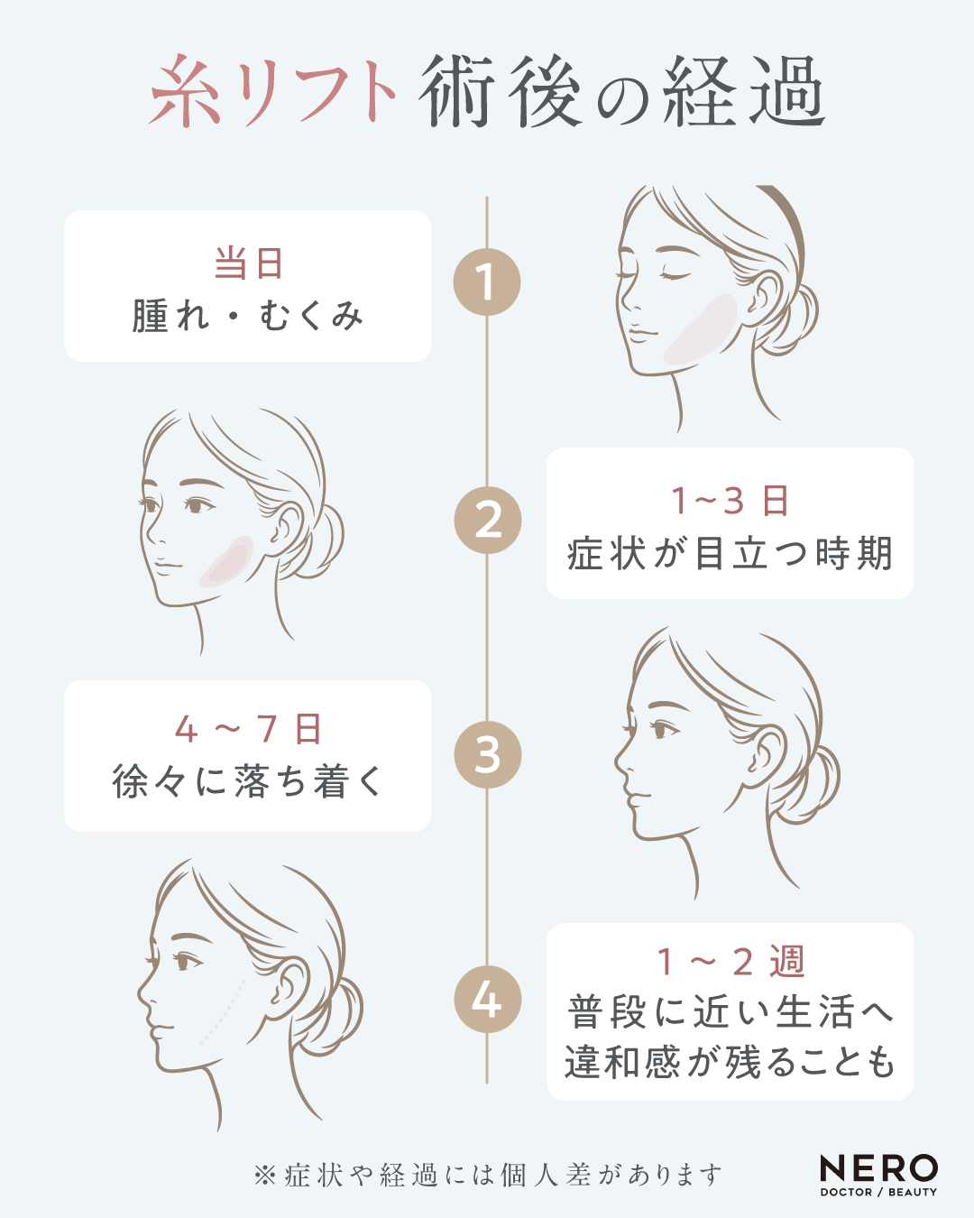糸リフトの施術後の経過を示した図