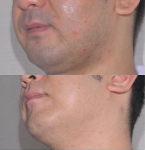 とりい皮膚科クリニック医療脱毛施術前後の症例画像