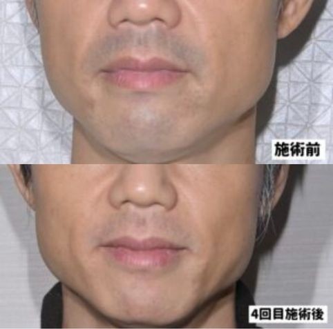 とりい皮膚科クリニック医療脱毛施術前後の症例画像