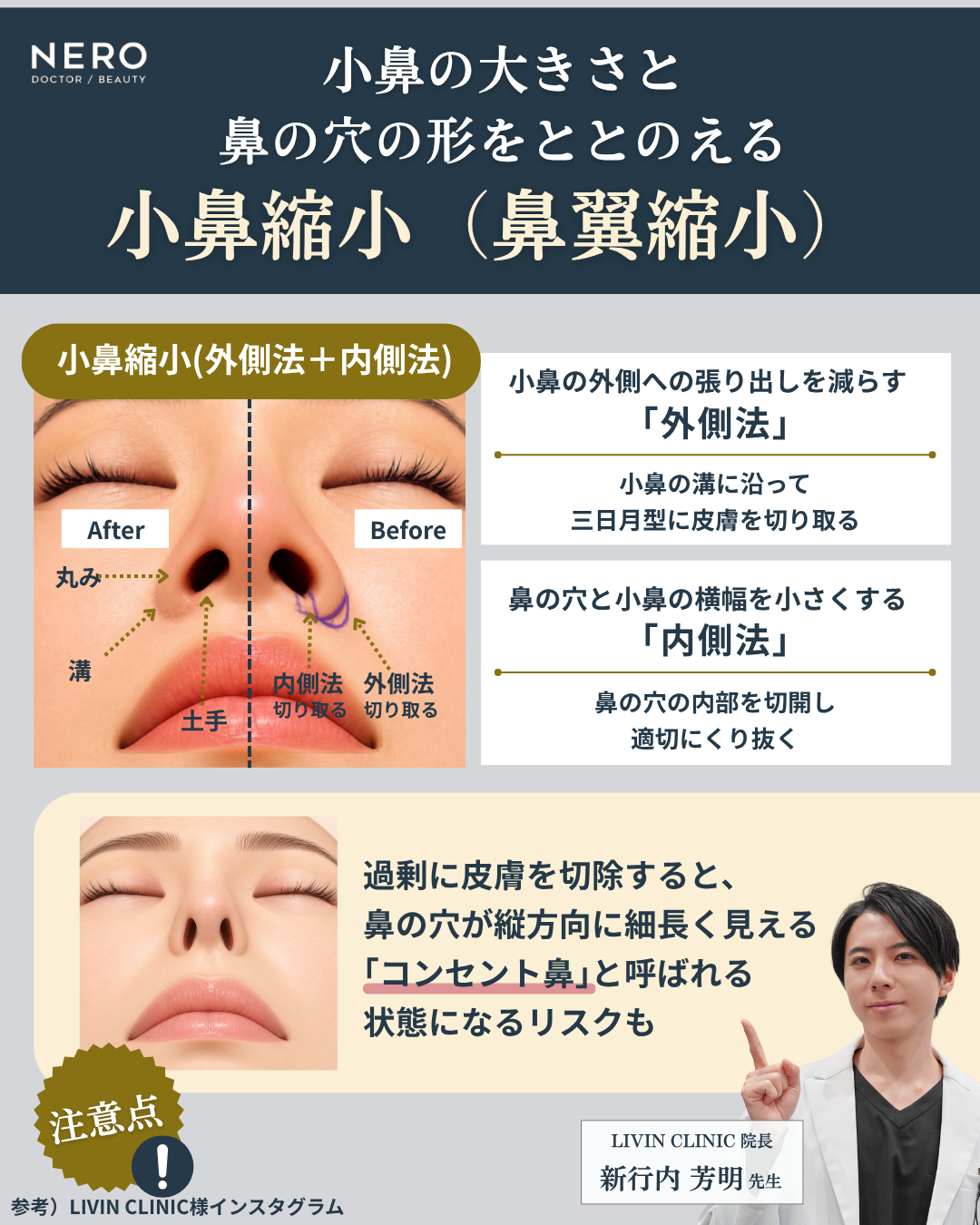 小鼻縮小(鼻翼縮小)ビフォーアフター解説図