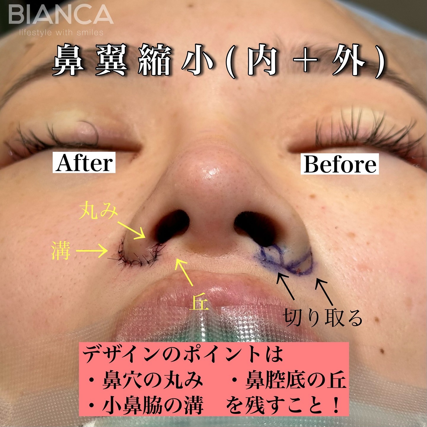 小鼻縮小(鼻翼縮小)内側+外側 顔の左右の小鼻で施術前後を示した症例画像